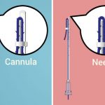 What Is The Microcannula Technique?